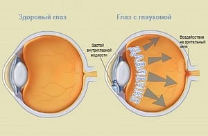 глаукома