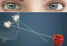 strabismus