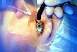 операции на глазах