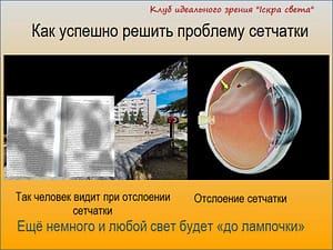 отслоение сетчатки
